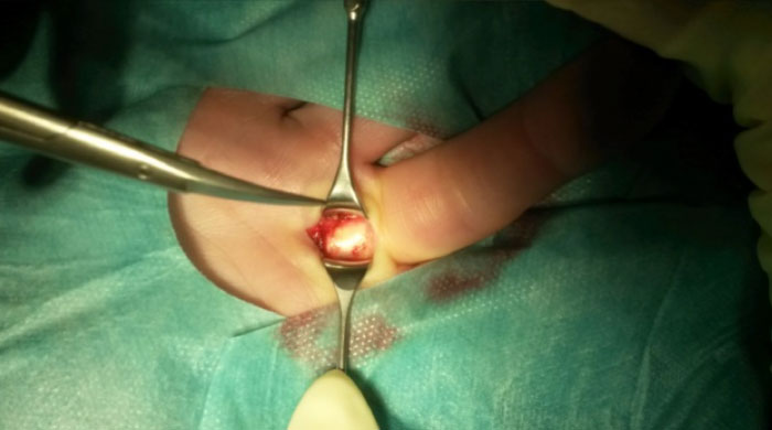 Operation des Schnellenden Fingers / Ringbandresektion (verwandt mit der Dupuytrenerkrankung)