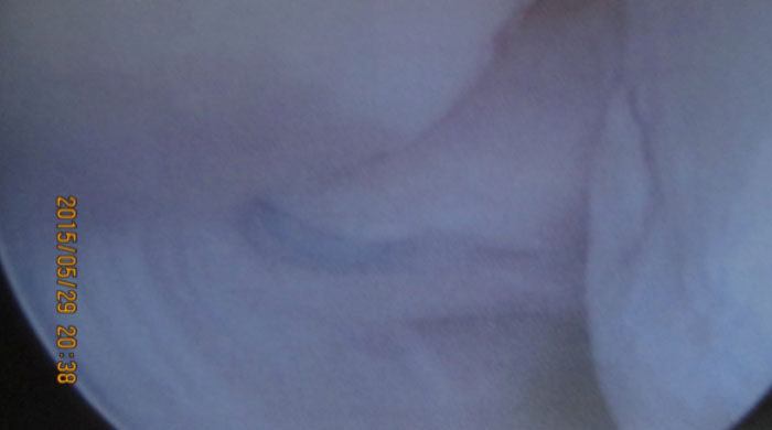 Arthroskopisches Bild eines Knorpelschadens im Sprunggelenk nach Sprunggelenksdistorsion (Bänderriss) als Langzeitfolge